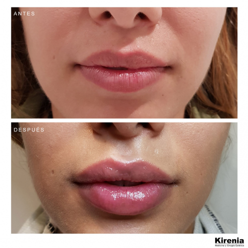 Aumento de labios